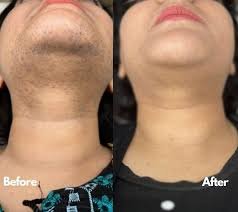 BTL Emsella Treatment Result