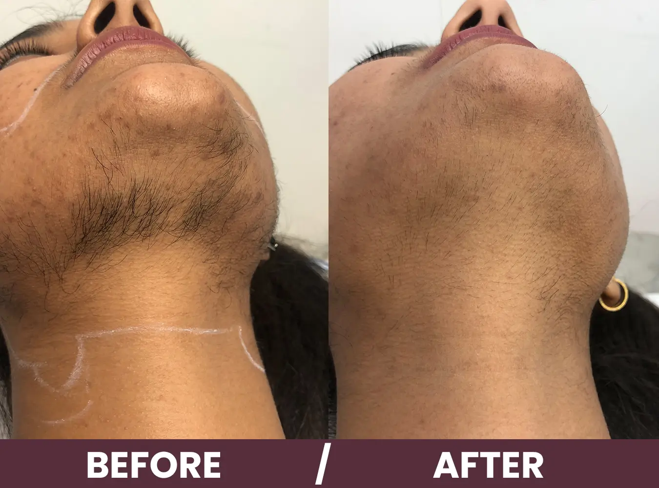 BTL Emsella Before and After