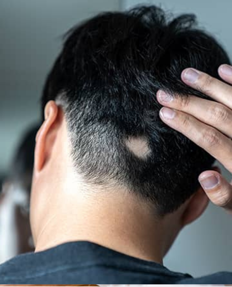 Alopecia Areata