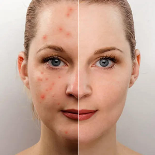 Acne & Acne Scar Treatment
