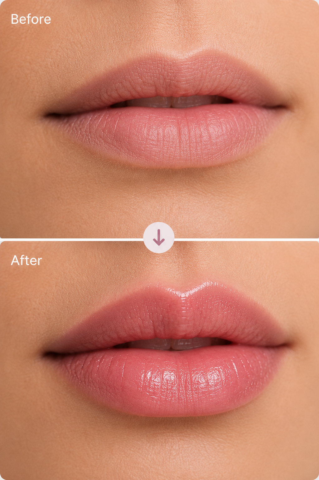 Lip Filler