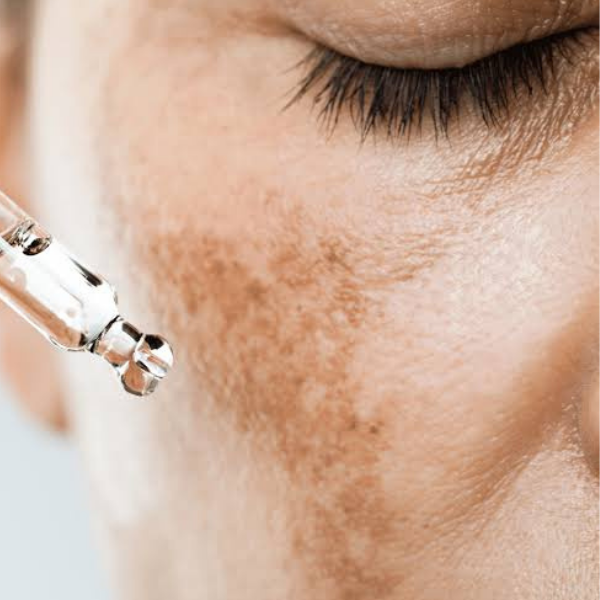 Melasma Treatment