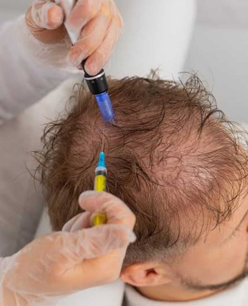 Mesotherapy Treatment