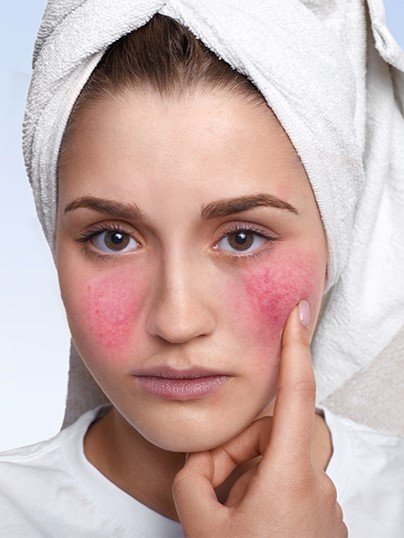 Rosacea Treatment