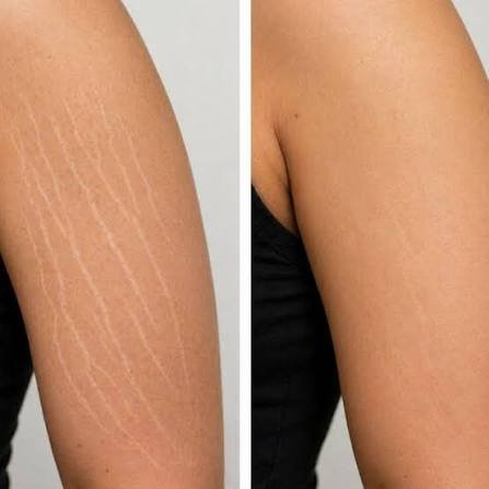 Stretch Marks Removal Treatment