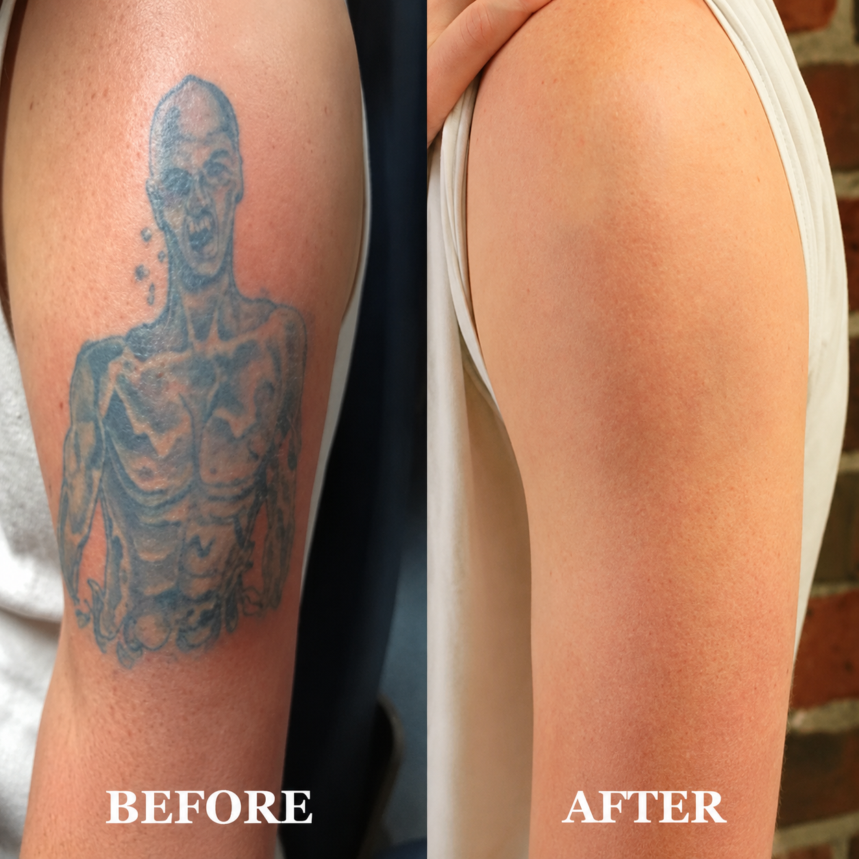 Laser Tattoo Removal