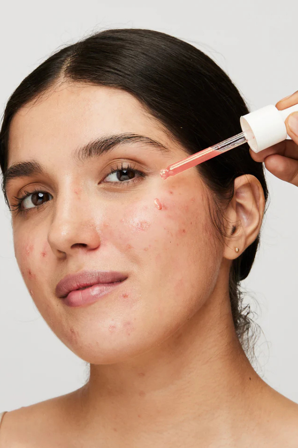 Pigmentation Treatment